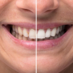 How to Get White Teeth Fast: 9 Simple Tips